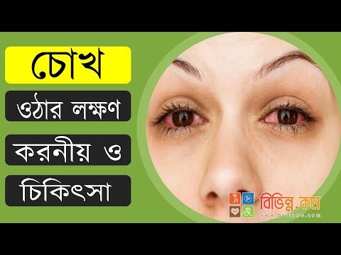 ভিডিও: কীভাবে গোলাপী চোখের (কনজাংটিভাইটিস) চিকিত্সা করবেন (ছবি সহ)