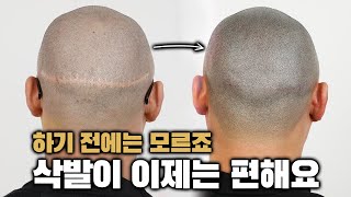 [SMP 2년차] 모발이식 흉터때문에 짧은머리도 못했는데..