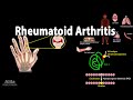 Rheumatoid Arthritis, Animation