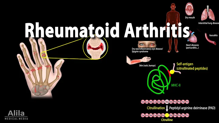 Rheumatoid Arthritis, Animation - DayDayNews