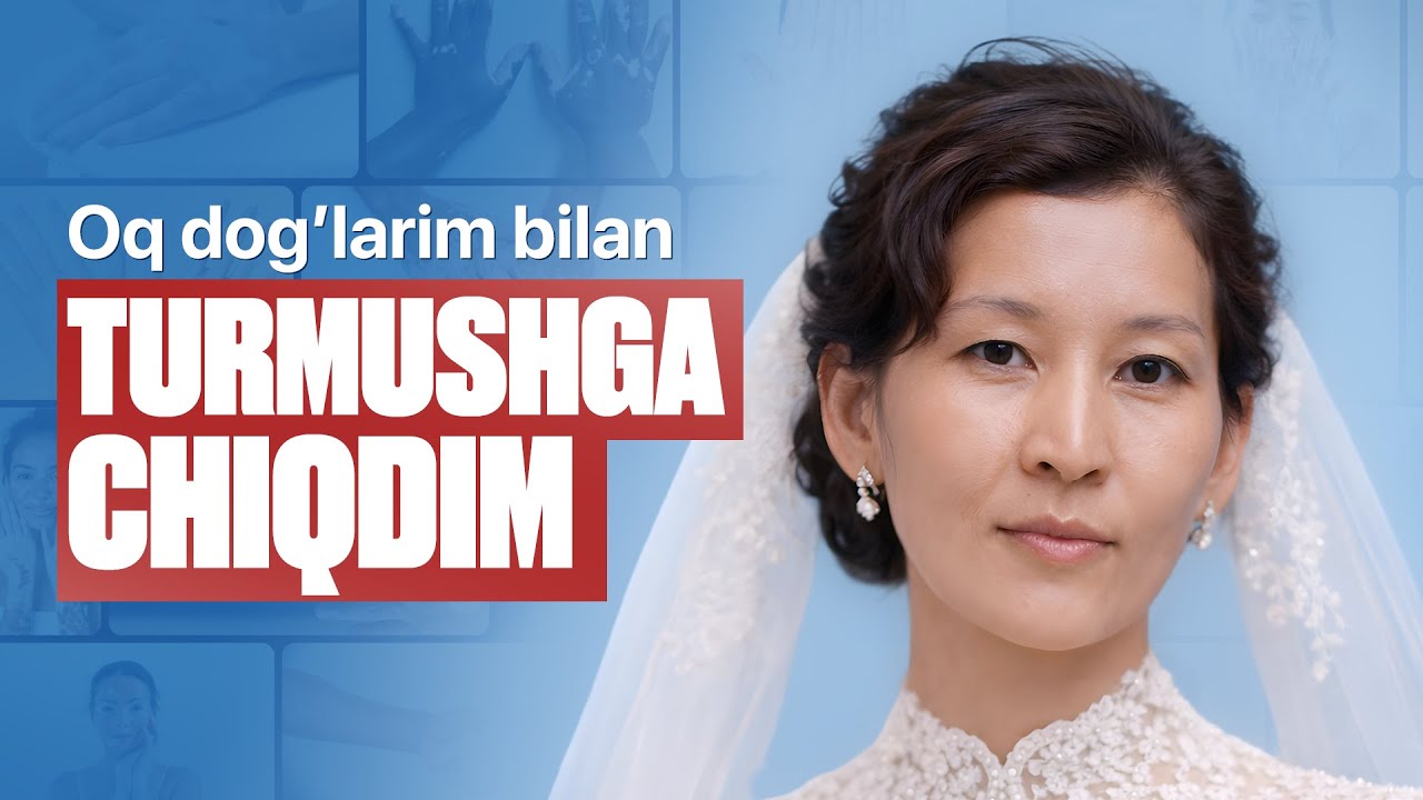 Oq dog‘lar (vitiligo ) ning davosi bormi? Mening tajribam haqida