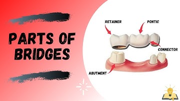 Parts of Bridge | Fixed Partial Denture (FPD)