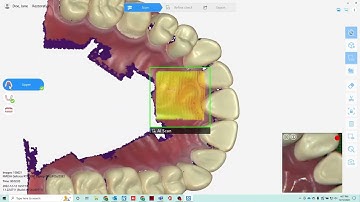QUICKSCAN IOS 3D Intraoral Scanner by Runyes Software Demo