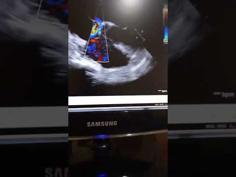 الايكو بالمنظار بيشخص حالات مهمه منها الثقب بين الاذينين في الكبار عيادة القلب في بيتك