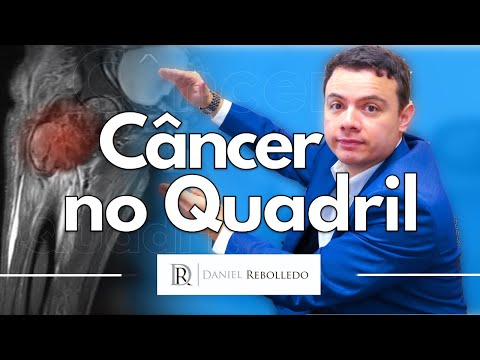 Vídeo: Dor No Quadril E Câncer: Por Que Sua Dor No Quadril Pode Ou Não Ser Câncer