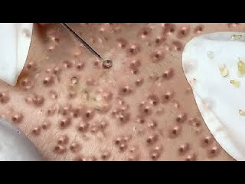 Video Big Cystic Acne Blackheads Extraction Blackheads &... - youtube