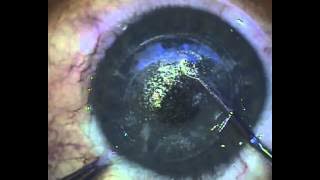 ReLEx SMILE: Minimally invasive laser eye surgery