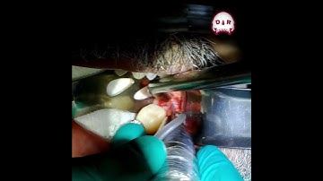 Distal Root Fracture: Wisdom Tooth Extraction