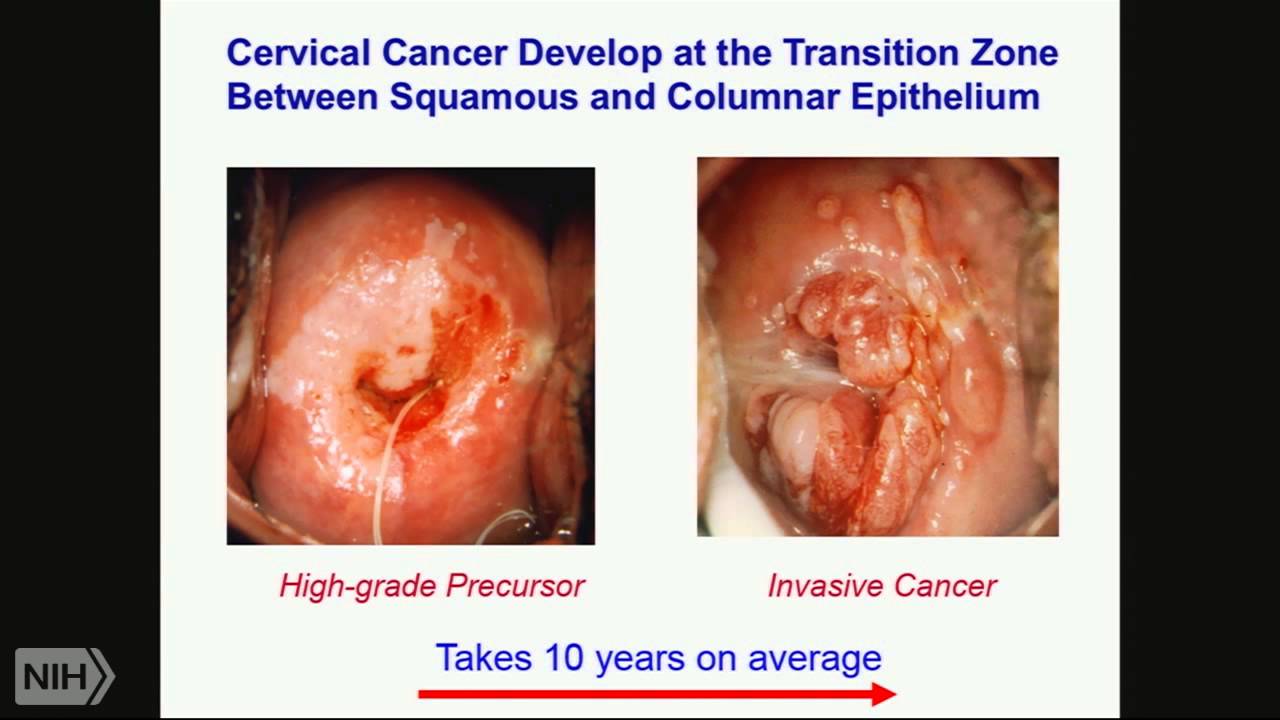 cervical cancer 