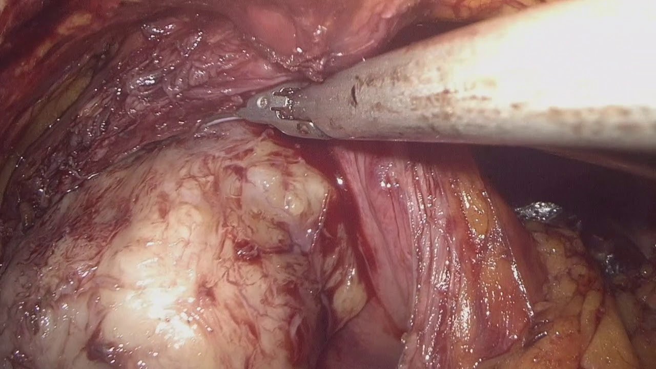 emorragia post intervento prostata emorragia post intervento prostata