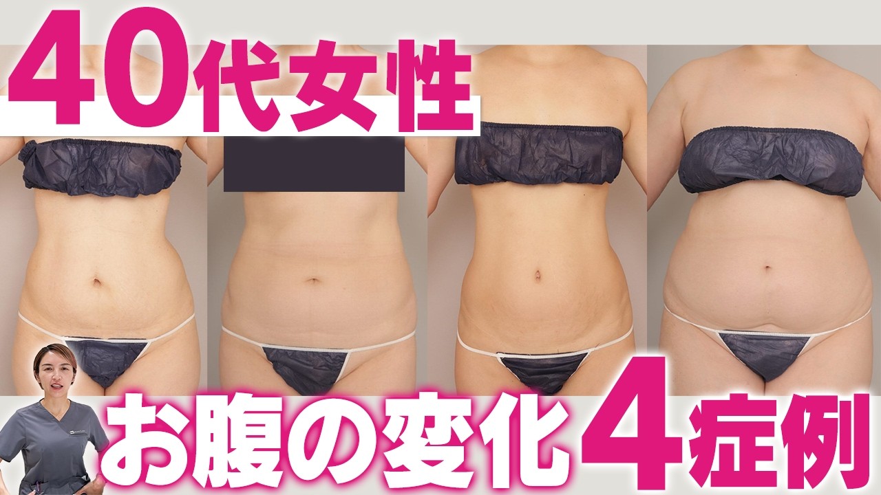 【脂肪吸引】40代の落ちない浮き輪肉どう変わる？症例写真でBMI・体型が違う4人の変化を解説！｜脂肪吸引の母#269