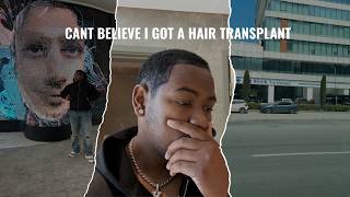 I Actually Got A Hair Transplant!