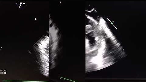 Thrombus in the left atrial appendage in a patient with AF