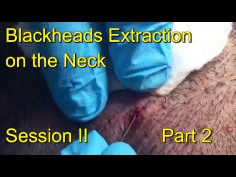 Blackheads Extraction on the Neck. Session II- Part 2