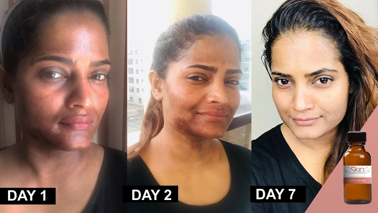 25 Tca Chemical Peel At Home Method And Progress By Hina Urduhindi