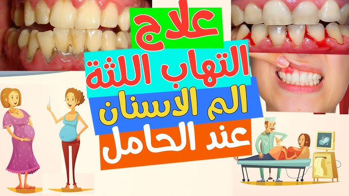 علاج التهاب اللثة أثناء الحمل وألم الأسنان أثناء الحمل. يوتيوب