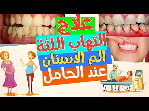 فيديو: كيف تتخلصين من وجع الاسنان أثناء الحمل