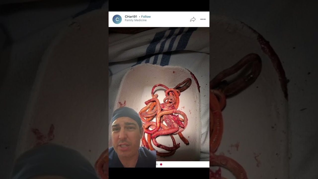 A Patient With Stabbing Wound Has Worms Coming Out Of Them 