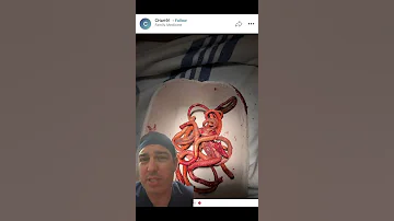 A Patient With A Stabbing Wound Has Worms Coming Out Of Them 