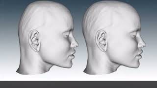 Эстетическая краниопластика с индивидуальным имплантом | Occipital Augmentation with Custom Implant