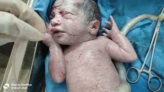 Newborn Baby First Suction & Initial Care | Delivery Room Procedure 💜 🫂🤗
