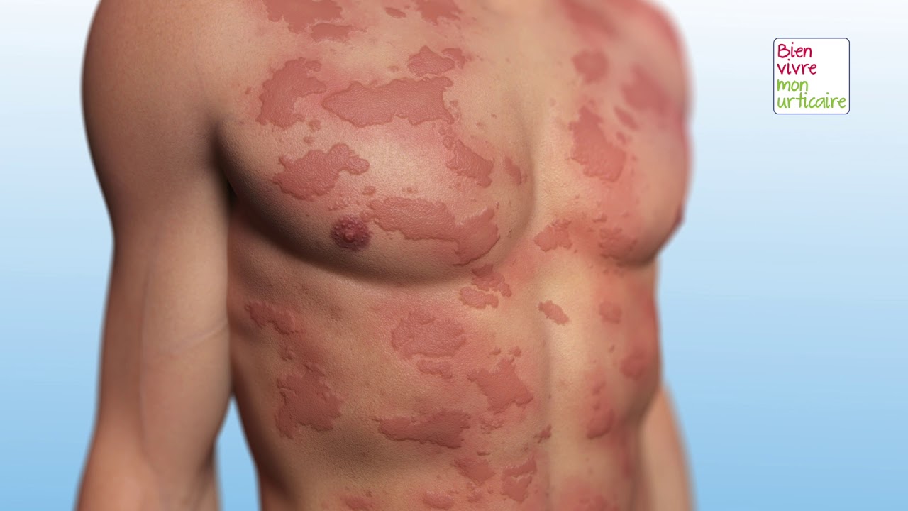 Urticaire et allergie. Quelles sont les différences ? YouTube