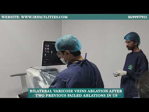 Bilateral Varicose veins ablation after two previous failed ablations in US