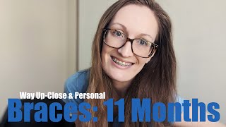 ADULT BRACES 11 MONTHS UPDATE: Up-Close Braces Update, Wobbly Teeth, No More Steel Tie