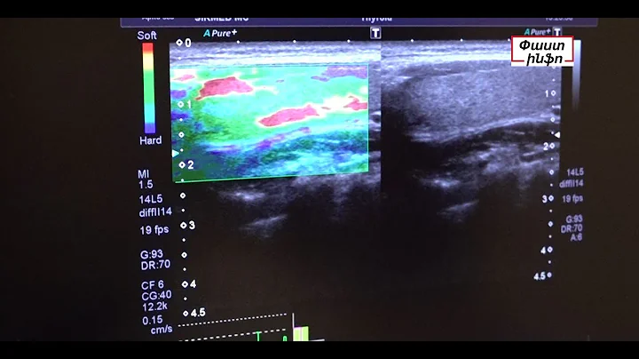 Վահանաձև գեղձի չարորակ հանգույցների բացահայտումն այլևս հեշտ կլինի