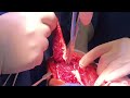 Neglected Posterolateral Elbow Dislocation: Complete Surgery Step-by-Step