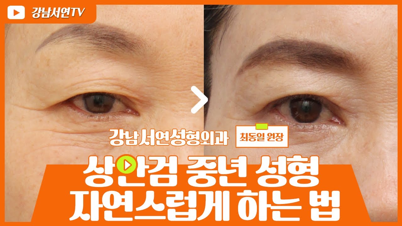 [Ганнам Соён Гоо сайхны мэс заслын эмнэлэг] Гоо сайхны мэс заслын судалгаа I Дунд насны дээд зовхины мэс заслыг хэрхэн байгалийн харагдуулах вэ? I Дунд насны нүдний мэс засал