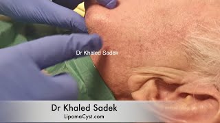 Massive Face Cyst. Dr Khaled Sadek. LipomaCyst.Com