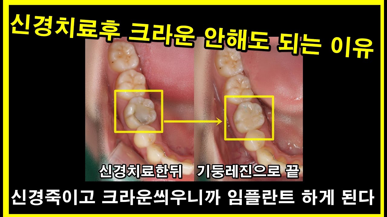 신경치료는 당해도 크라운은 당하지 맙시다. 씹을 때 아프다고 바로 신경죽여버리는 건 잘못된 진료입니다.