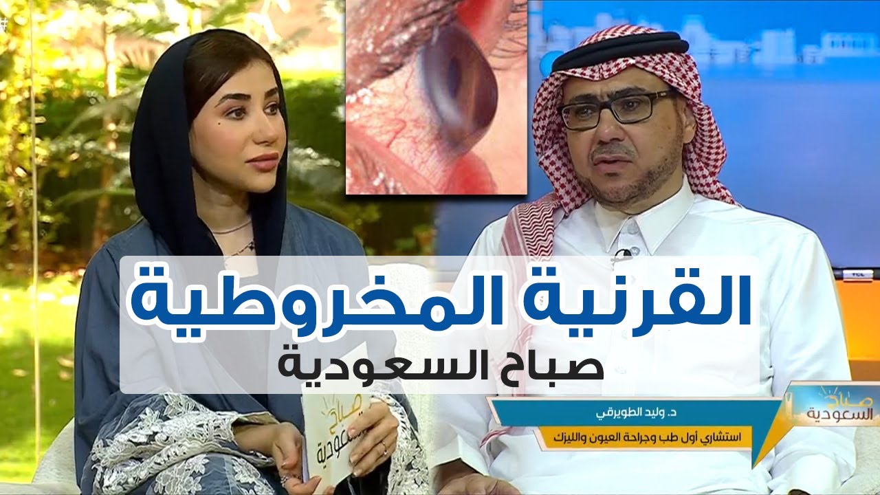 القرنية المخروطية وطرق علاجها || د. وليد الطويرقي || صباح السعودية