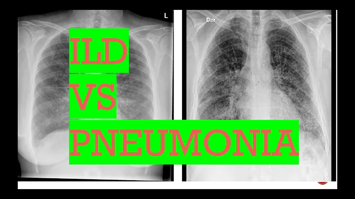 Chest X-ray/ interstitial lung disease vs Pneumonia/Types of opacities in lungs
