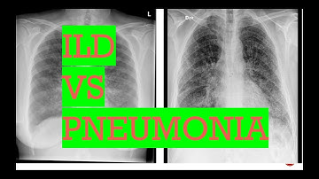 Chest X-ray/ interstitial lung disease vs Pneumonia/Types of opacities in lungs