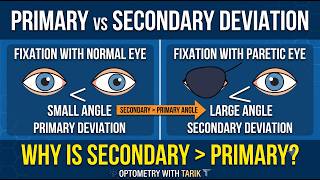 Primary vs Secondary Angle of Deviation Made Easy | Paralytic Strabismus