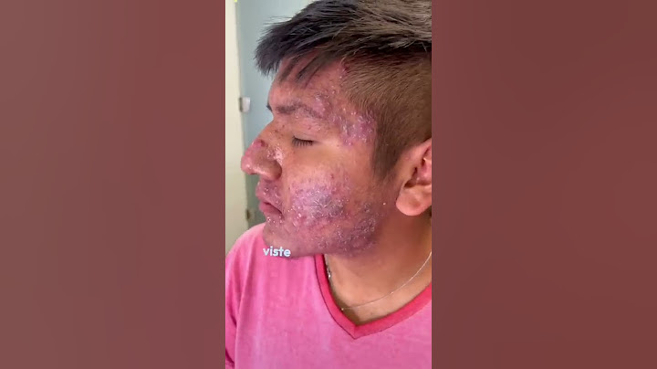 🤩Consigue mejorar tu acné en unas semanas dermatólogo militar viste cambios ? Dermatólogo militar