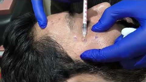BOTOX FOR CROW FEET