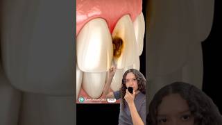 Caries Entre Los Dientes