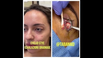 Scarless chalazion drainage