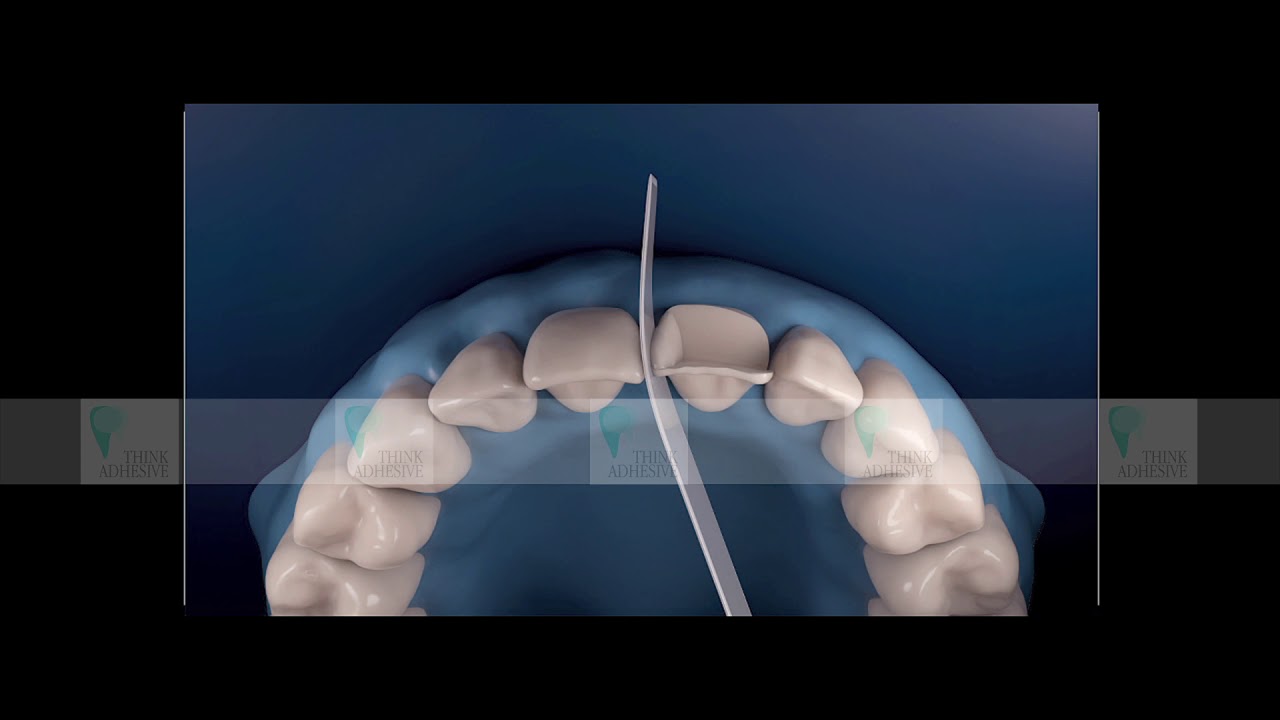 THINK ADHESIVE PILLS - IL PUNTO DI CONTATTO NEI SETTORI ANTERIORI: UN NUOVO APPROCCIO