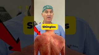 Shingles  You Don't Want This! #shorts