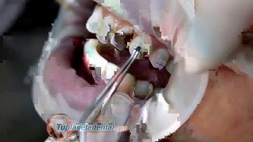 Mắc cài Brackets Clarity Advanced 3M Unitek