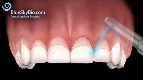 Patient Treatment Videos: Gingivectomy