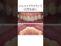 30代女性 ジルコニアクラウンで自然な歯に #歯 #歯科医院 #歯医者 #症例 #セラミック治療 #ジルコニアクラウン