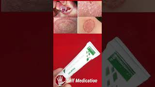 fungal skin infection cream | luliconazole cream #shorts #short #shortsyoutube