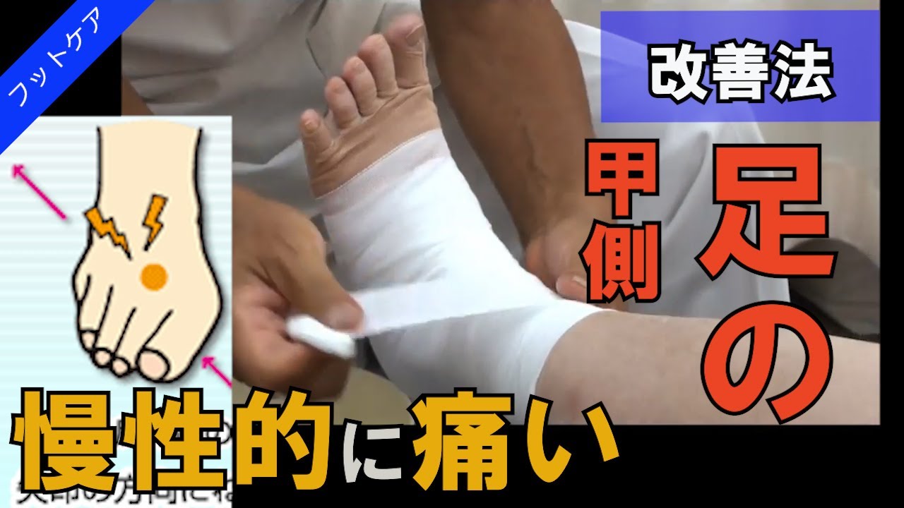 足背部の痛み 中足骨疲労骨折 笠原巖の 足の痛み 専門サイト