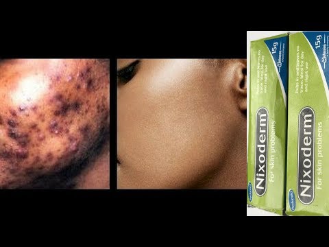 THIS PRODUCT WOULD GET RID OF YOUR ACNE/PIMPLES OVERNIGHT