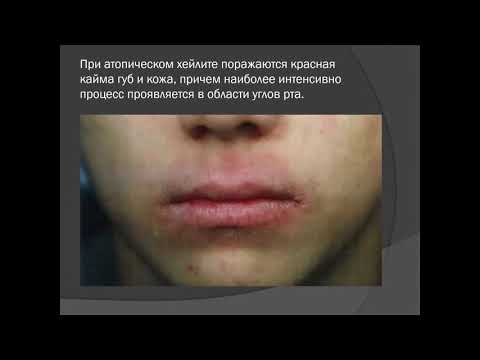 Основные аспекты диагностики и лечения хейлитов